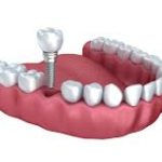 lom turismo dentale implantologia