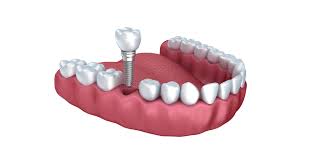 impianto lom turismo dentale implantologia