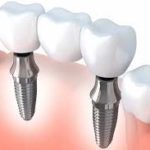 lom turismo dentale implantologia