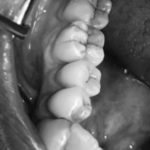 riabilitazione singolo dente in disilicato lom2