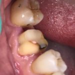 riabilitazione singolo dente in disilicato 