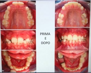 lom ortodonzia bambino